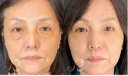 【肌質改善】リベルハーブリーリング ¥55000→¥22000