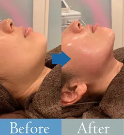 Facial【驚くほどの小顔✨ミニモ限定🉐】驚くほどの小顔❣️フェイシャル4000shot+美顔器+軽いマッサージ