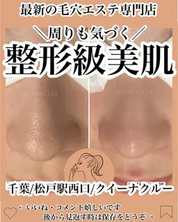 毛穴エクストラクションプロ/長年のいちご鼻から卒業/毛穴のザラつき/黒ずみ/毛穴の開きにも◎極上マッサージ付き