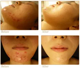 ハーブピーリング