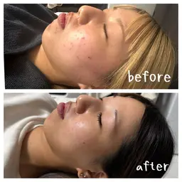 ミニモセール🩵高浸透ハーブピーリング🌿『毛穴/ニキビ跡/シミ/引き締め/赤み/くすみ/トーンアップ』