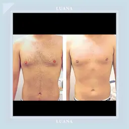 【メンズ全身脱毛(顔込VIO無)+襟足と背中シェービング付き】¥13000 施術45分 剛毛・日焼けOK/メンズカット