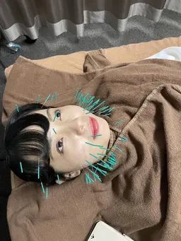 トータルエイジング美容鍼