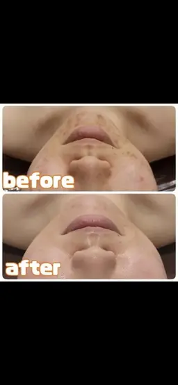 🍓🍷脱毛とフェイシャルのいいとこ取り🍓🍷ピーリング＆パック付き❤韓国肌・美白・毛穴・小顔・化粧ノリUP🍓🍷