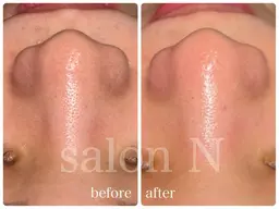 毛穴洗浄🫧¥6,600→¥3,300✨スキンケアでは取り切れない汚れをスッキリ綺麗に♪(鼻のみ)