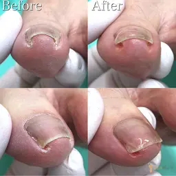 【巻き爪・陥入爪補正】口コミにご協力頂ける方限定⭐︎1カ所の陥入爪補正✨特許取得の矯正器具を使って綺麗に補正します🤗