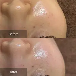 【初回】毛穴と肌の底上げケア《esV10》