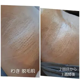 ワキ脱毛 美肌光脱毛