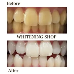 【学割U24】初回2回集中ホワイトニング|透明感アッププログラム