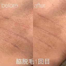 【メンズ♂】全身脱毛