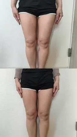 脂肪撃退キャビテーション45分（1部位）