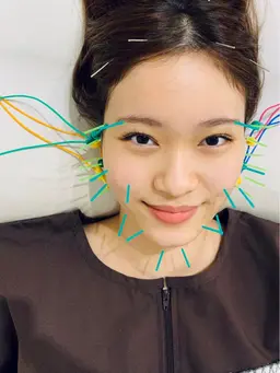 【モニター施術】即効リフトアップ！フェイシャル小顔美容鍼【メイクしたままOK ／メンズOK】