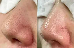 ♦︎今大人気の毛穴エクストラクションプロ　毛穴ケアコース♦︎