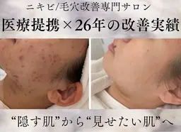 【モニター募集】残り5名/人気No1ニキビコース☆