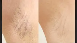 レディースカウンセリング、施術箇所相談。Sパーツ