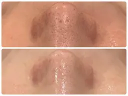 【毛穴･ニキビ集中】REVIハーブピーリングお試し🌿+ヘッドマッサージ付き ¥6,600