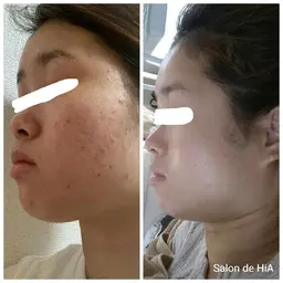 ✨新登場✨60分🕑️肌質改善🌿日本製ハーブピーリング🌿剥離なし◎ダウンタイムなし◎痛みなし◎即メイクOK◎