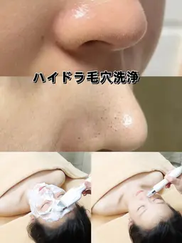 🉐SALE🉐毛穴黒ず🥚つるっんとたまご肌👍ハイドラ毛穴全顔+ヒアルロン酸導入+小顔+パック💚 60¥3990