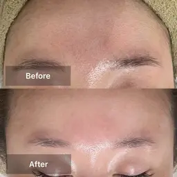 ◎ミニモSALE☆毛穴ツルツル韓国肌ハーブピーリングお試しコース☆デコルテケア付き(口コミにご協力頂ける方)