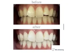 セルフホワイトニング🦷✨【30分照射】ミニモ限定価格