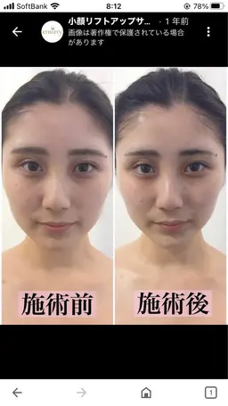 今だけキャンペーンクーポン‼️今月ご予約ご来店限定❗️即実感の小顔フェイシャル❗️40分5,000円