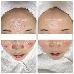 どうしたらニキビが治るのかわからない…自分では限界を感じている方👉150通りの施術からあなたに合わせた施術をご提供🌈