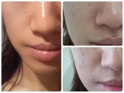 【ご新規様限定】いちご鼻卒業キュッと毛穴引き締め‼️