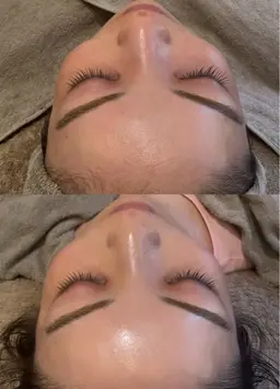 人気No.3【毛穴洗浄+電気美容鍼】エレクトロポレーション導入付き👃ごっそり汚れを取り除き美肌&小顔を✨卵肌🥚