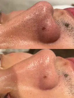 🚿毛穴洗浄ハイドラワン🚿頑固な皮脂汚れや角栓同時に頭皮もフェイシャルマッサージ１０分＋ハイドラ４０分＋頭皮洗浄10分