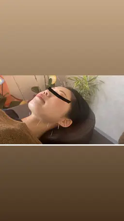 【たるみケア、むくみ改善に】美容鍼お試し♪