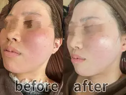 🫧‪復元パック🫧‪  肌のくすみ、赤み、ニキビ跡、シミ