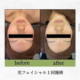 光フェイシャル✨ニキビ跡、赤ら顔、シミ、しわ、たるみが気になる方へオススメです!