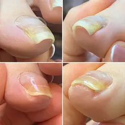 巻き爪 解放 1指 （片足親指）