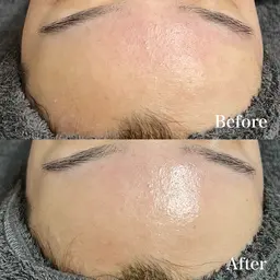 🍋【ニキビ毛穴シミに】REVIハーブピーリング《陶肌トリートメント》➕VCFリキッド 0.8ml