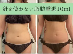 👑人気NO.1👑針を使わない脂肪撃退‼️後戻りゼロ🫶 +ハイパーナイフEX 🔥 【お好きな箇所1部位集中】