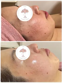 【ニキビ悩み】ハーブピーリング