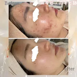 剥離ほぼなしハーブピーリング&保湿パック🌿