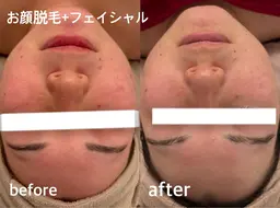 美肌顔脱毛(シェービング付き)+毛穴ケア+美白フェイシャルパック¥11,000▶︎2回¥13,000円
