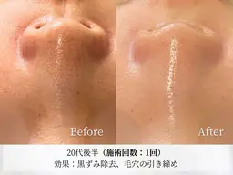 NEWオープン特別《毛穴洗浄＋毛穴吸引》気になる鼻の毛穴ごっそりとれる！ザラつき鼻さようなら✨️酵素洗顔付き