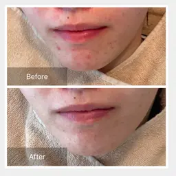 水光肌✨肌質改善🌿ハーブピーリング（剥離あり）ニキビ　ニキビ跡　クレーター　毛穴黒ずみ　美白　美肌