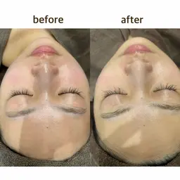 ハーブピーリング🌿剥離なし・ダウンタイムなし