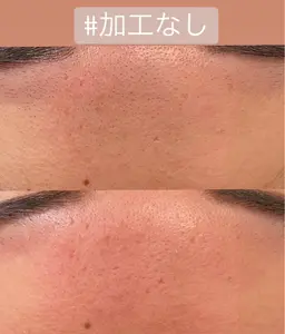 おでこのワックス脱毛