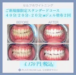 ご新規様限定🦷スタンダードコース40分(20分×2)✨メンズも大歓迎✨！☝️