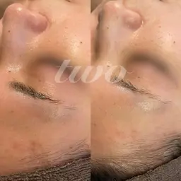 ハーブピーリング(顔+首)フェイシャルマッサージ有り