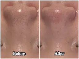 【毛穴詰まり・黒ずみ撃退！】韓国式毛穴洗浄🫧ハイドロフェイシャル ✨