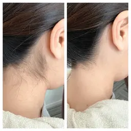 その場で美人うなじへ👩🏻‍🦰🤍うなじブラジリアンワックス