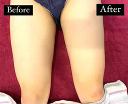 🌿太もも痩せ集中ケア🌿(太もも 表・裏)固まった老廃物、セルライト除去してスッキリさせる✨揉み解しマッサージ付き