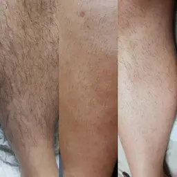 【メンズ脱毛】ひざ下脱毛5000円