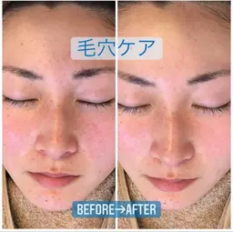 ✨水光肌毛穴洗浄✨マシンで即ツル肌へ❣️限定パック付💗美肌/毛穴/黒ずみ/引き締め/トーンup /ピーリング/韓国/