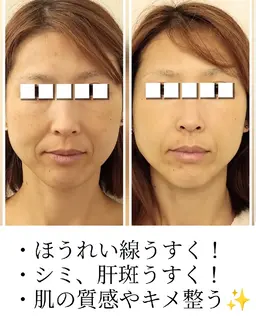 ハーブピーリング🌿剥離なし！シミ、シワ・たるみなどエイジングケアに最適♪